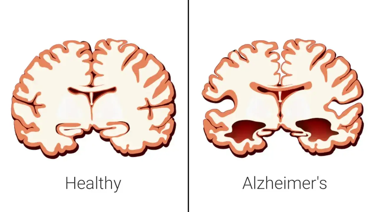 Porównanie mózgu zdrowego i z objawami choroby Alzheimera, która bywa nazywana cukrzycą typu 3. Widać zanik tkanki mózgowej.