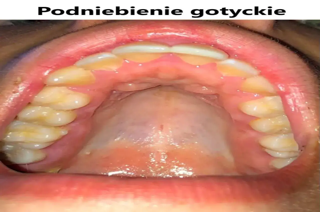 Widok jamy ustnej z zębami i podniebieniem. Charakterystyczne, wysokie podniebienie gotyckie.