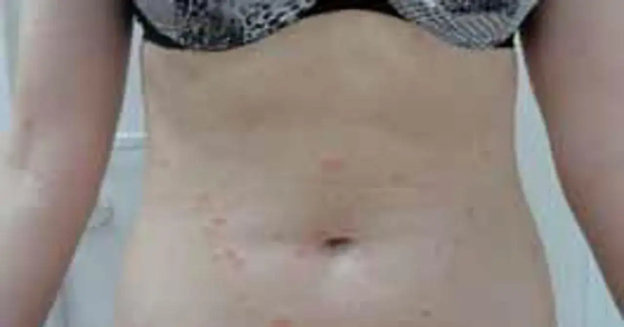 Skóra brzucha z licznymi, czerwonymi wykwitami, które mogą być objawem łupieżu Gilberta.
