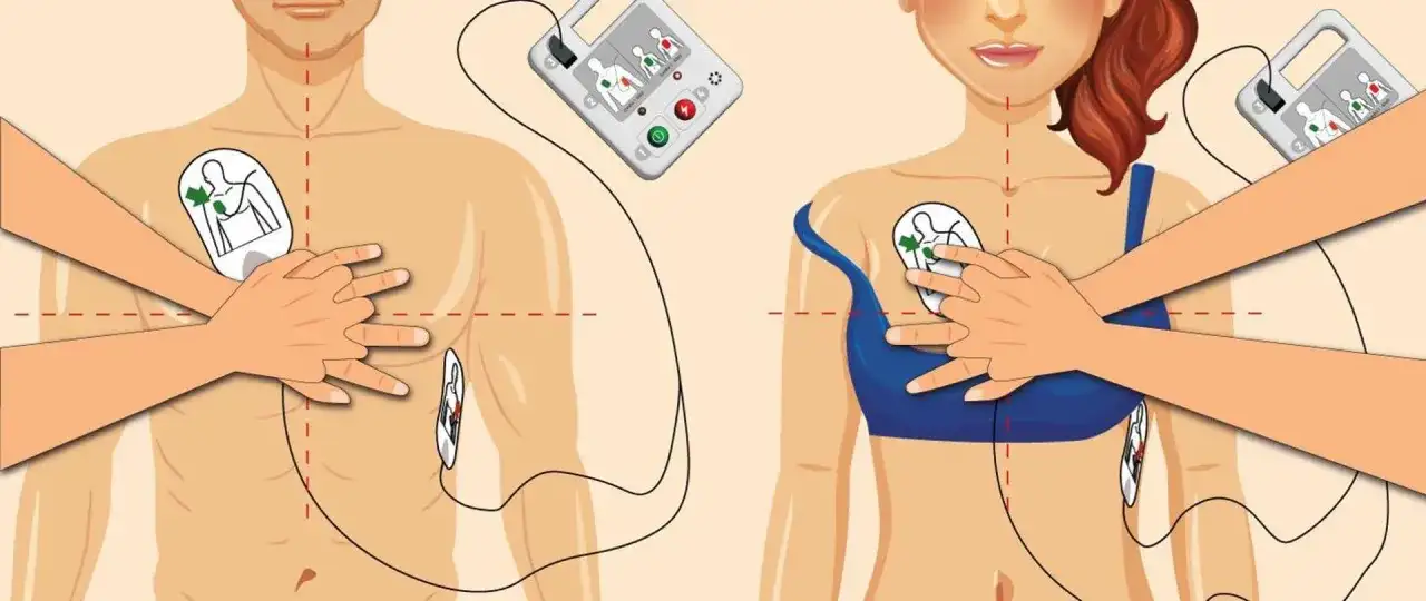 Instrukcja użycia AED: przyklej elektrody na klatce piersiowej, aby rozpocząć resuscytację.