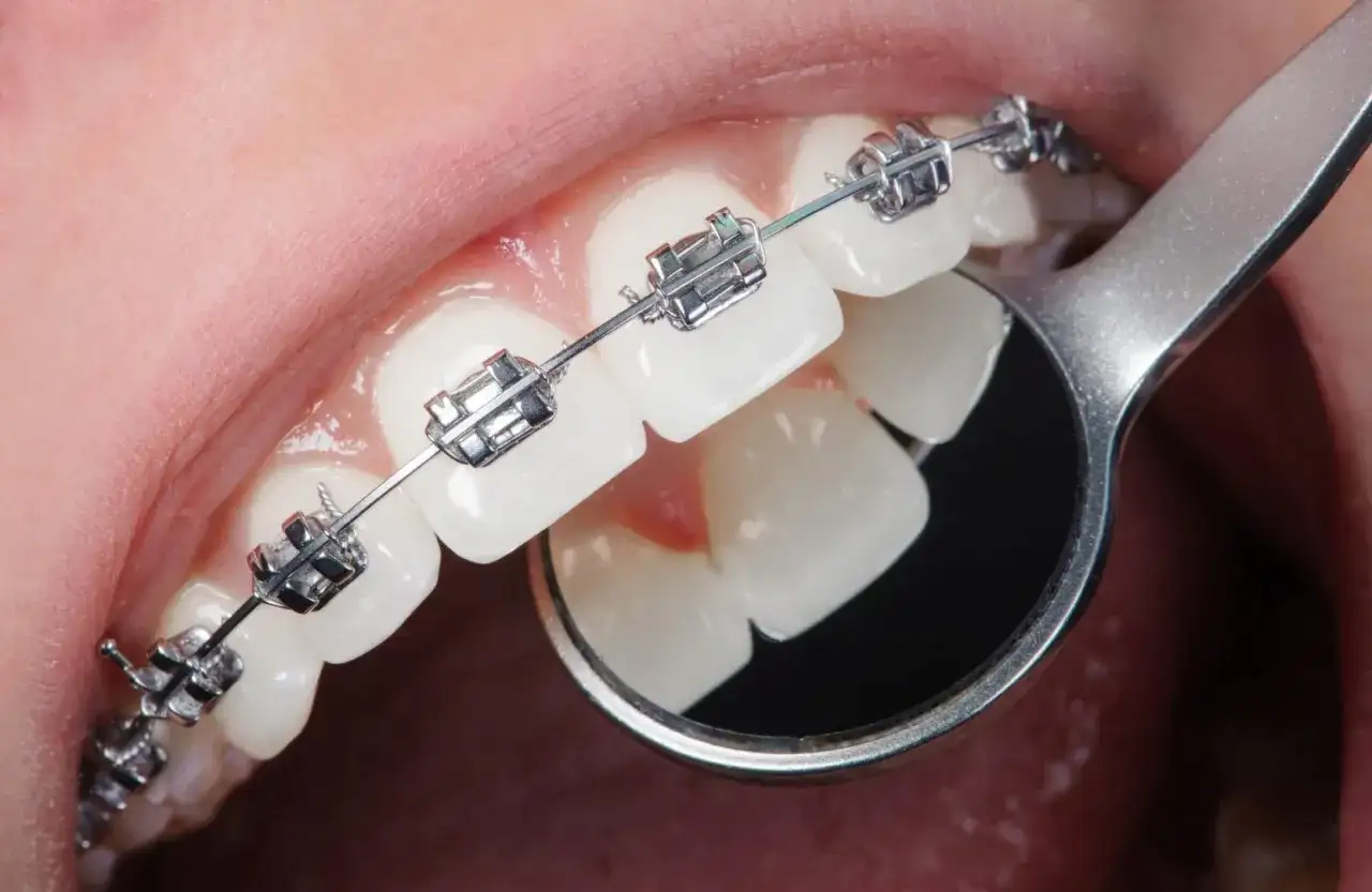 Dettaglio di denti con apparecchio ortodontico metallico. Un piccolo specchietto riflette i denti, mostrando come si mette l'apparecchio.