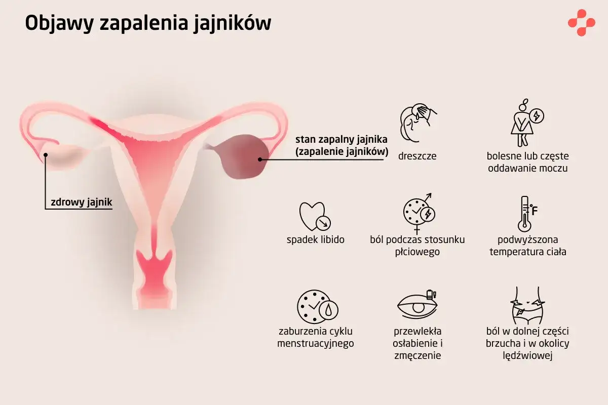 Ilustracja przedstawia budowę narządów rodnych kobiety z zaznaczonym zdrowym jajnikiem i stanem zapalnym jajnika. Wymienione objawy zapalenia jajników to m.in. ból brzucha.