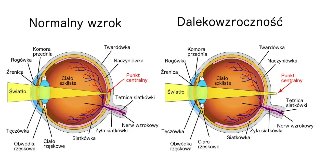 Na czym polega dalekowzroczność? Obraz pokazuje, że światło skupia się za siatkówką, a nie na niej, co powoduje nieostre widzenie.