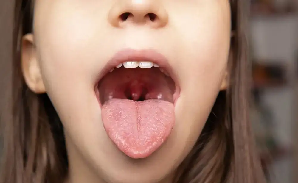 Jak uniknąć anginy? Skuteczna profilaktyka i wzmocnienie odporności