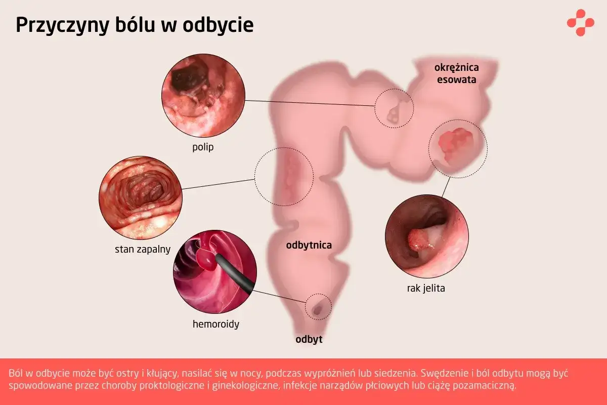 Ilustracja przedstawia przyczyny bólu w odbycie: polipy, stan zapalny, hemoroidy, raka jelita. Dyschezja może być objawem tych schorzeń.