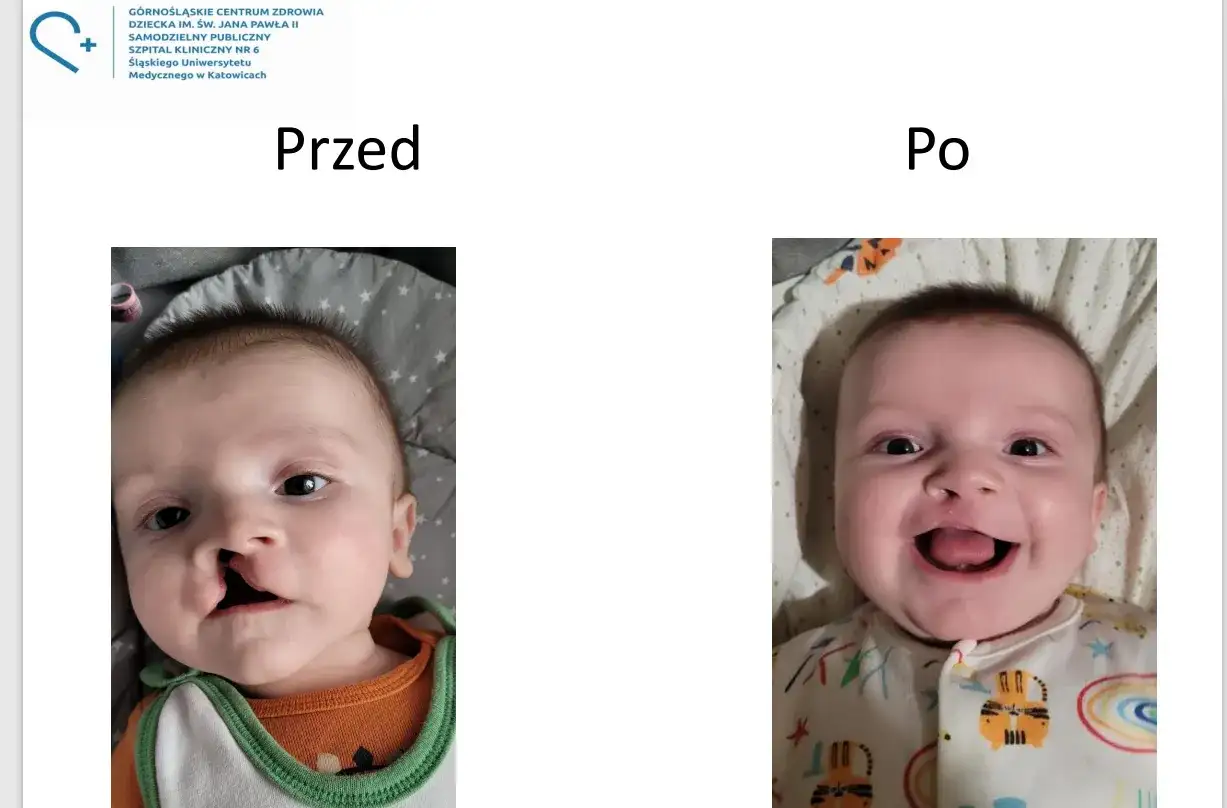 Uśmiechnięte dziecko przed i po korekcie rozszczepu podniebienia. Widoczna poprawa wyglądu twarzy.
