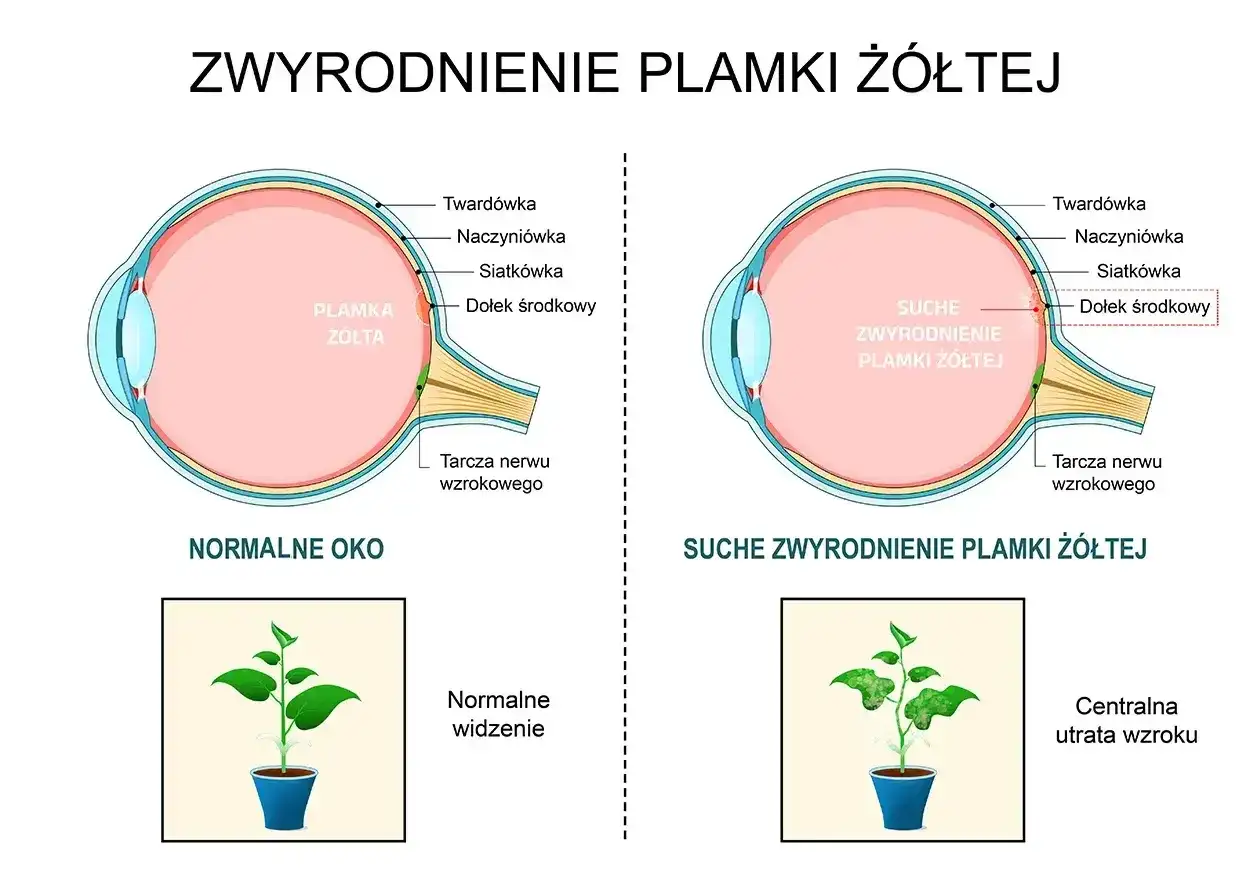 Porównanie normalnego oka z suchym zwyrodnieniem plamki żółtej. Obraz ukazuje, jak odbudowa plamki żółtej jest kluczowa dla normalnego widzenia.