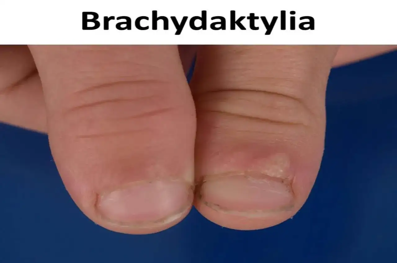 Zbliżenie na palce dłoni z widocznymi krótkimi paznokciami i skórkami, ilustrujące brachydaktylię.