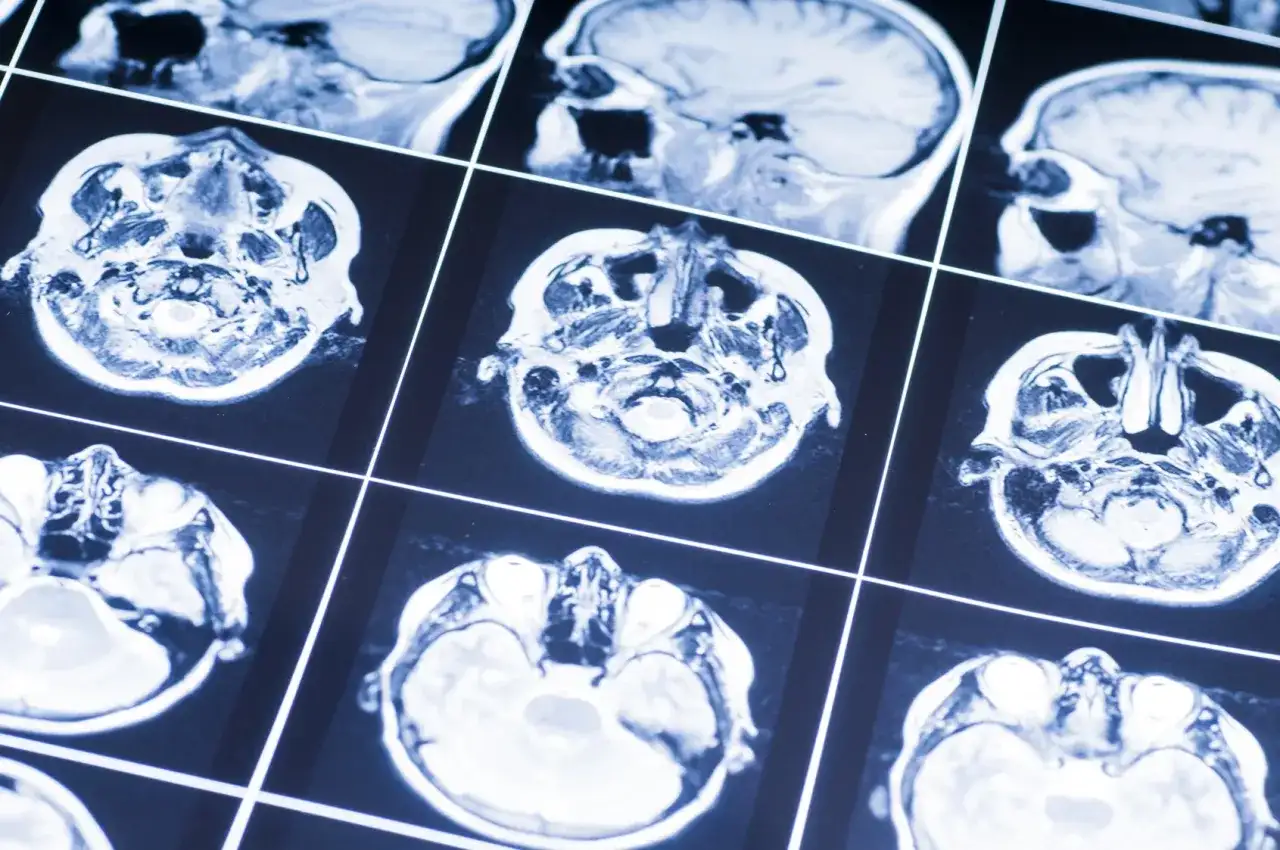 Przekroje mózgu na rezonansie magnetycznym. Obraz może pomóc w diagnostyce oponiak objawy, analizując strukturę tkanki mózgowej.