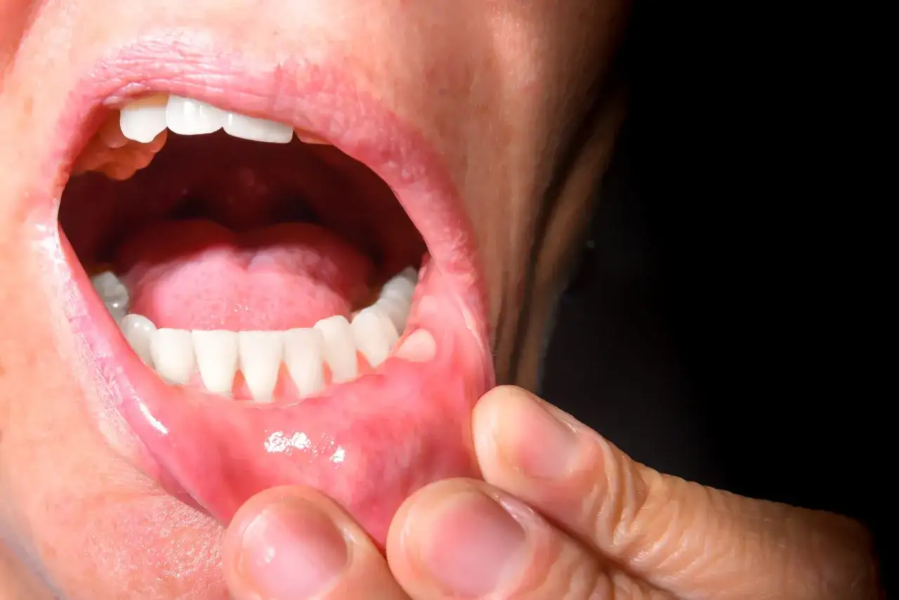 Afta w jamie ustnej jak leczyć? Widoczne białe owrzodzenie na błonie śluzowej policzka, obok zębów.