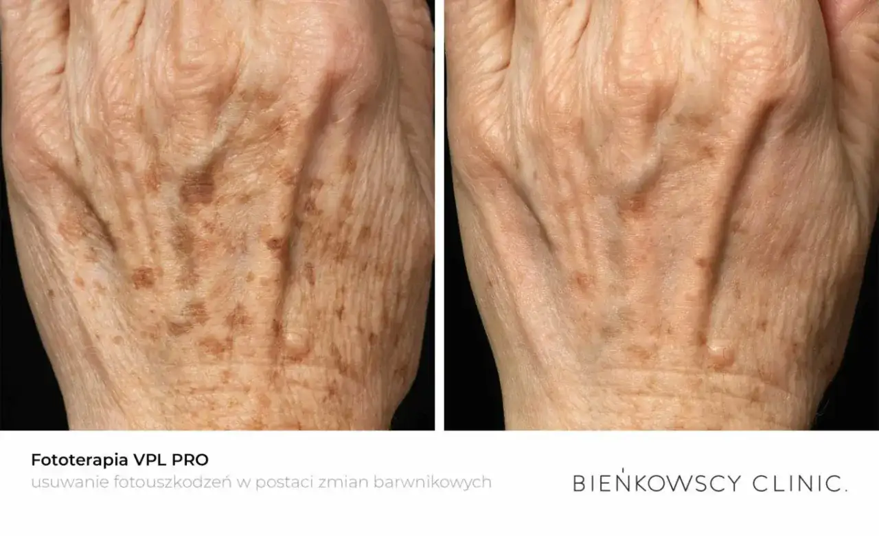 Dłoń przed i po fototerapii. Zmniejszona widoczność przebarwień spowodowanych nadmiarem melaniny.