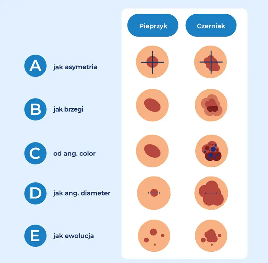 Podejrzane znamię? Diagnostyka czerniaka w Polsce poradnik