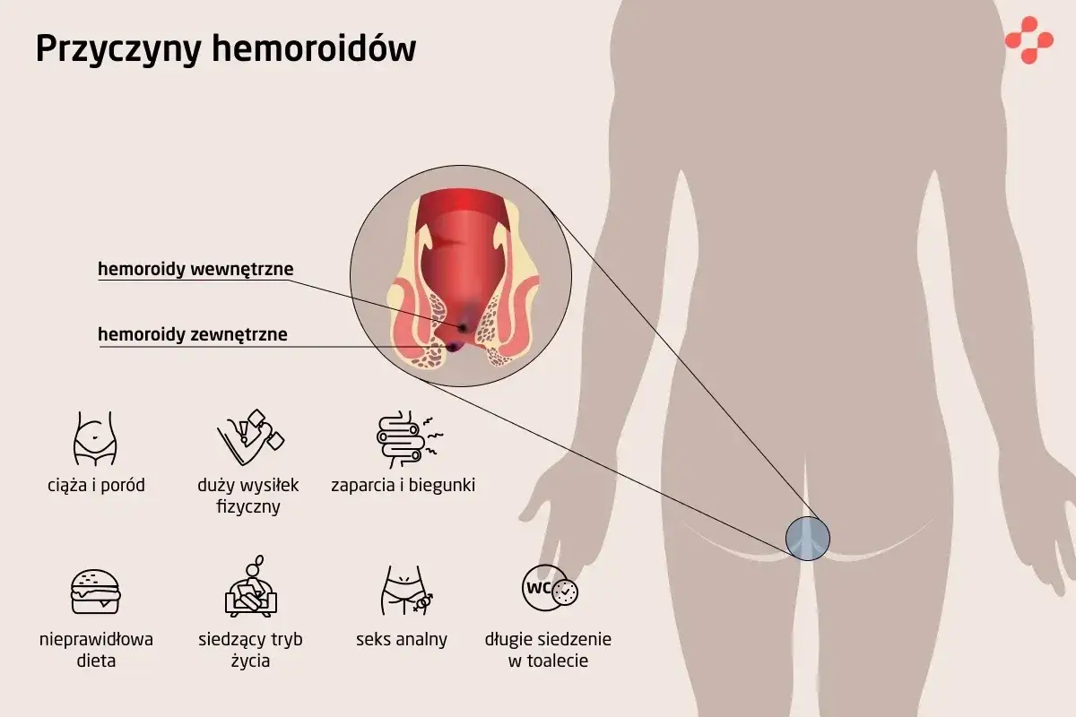 Hemoroidy? Przygotuj się do badania proktologicznego bez stresu!
