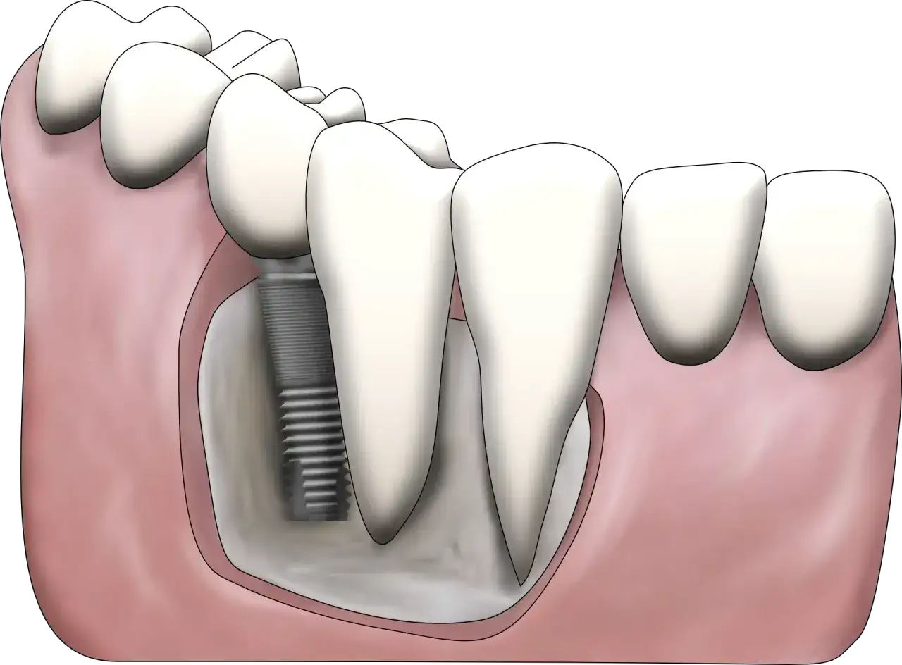 Ilustracja pokazuje, jak uzupełnić brak tylnych zębów za pomocą implantu stomatologicznego. Implant jest wkręcony w kość szczęki, a na nim osadzona jest korona zęba.