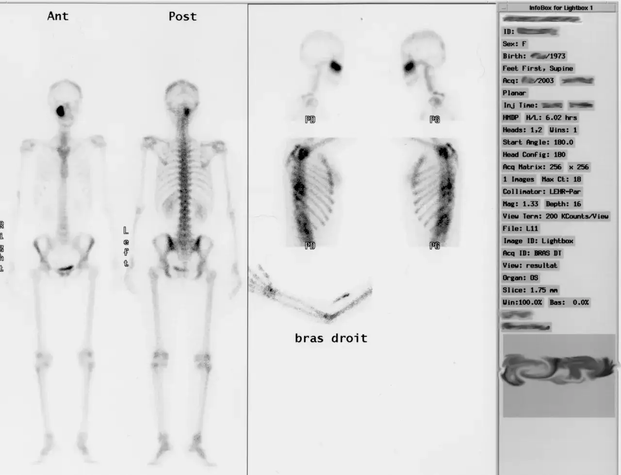 Scyntygrafia kości: Bez obaw! Przewodnik po badaniu