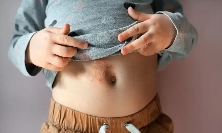 Czy alergia może pojawić się później? Zaskakujące fakty o alergiach