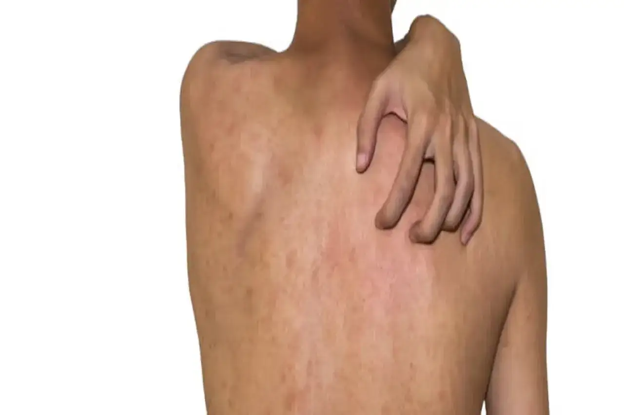 Alergia pokarmowa: objawy skórne, diagnoza i jak sobie radzić