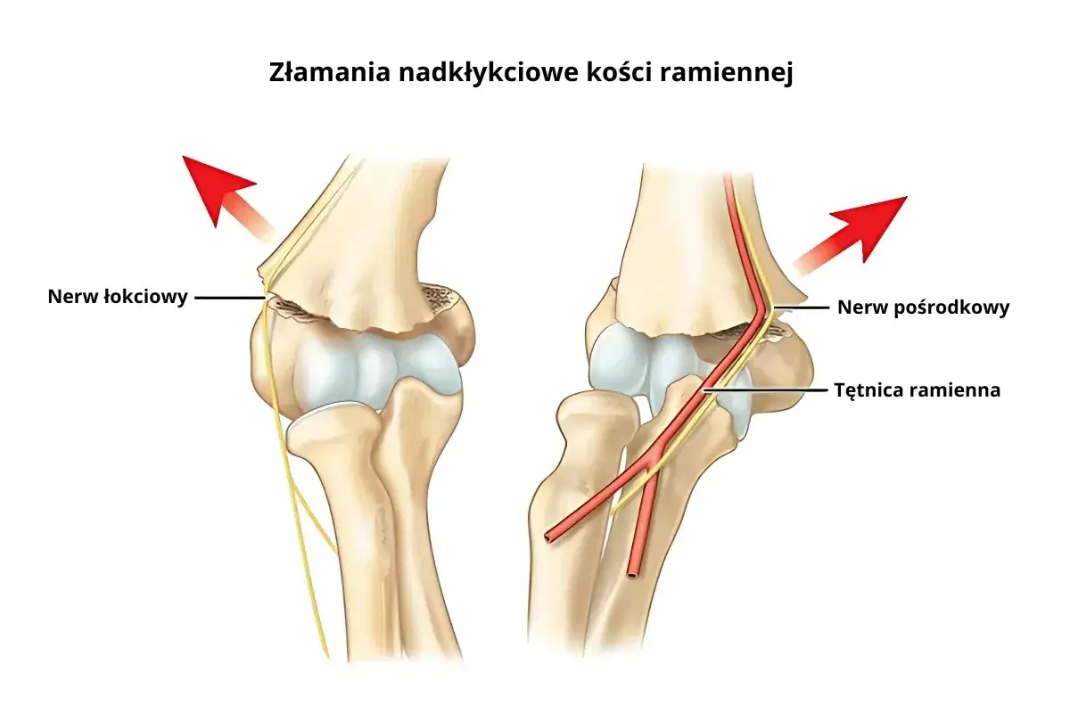 Złamania nadkłykciowe kości ramiennej po upadku. Widoczne uszkodzenie nerwu łokciowego i naczynia krwionośne.