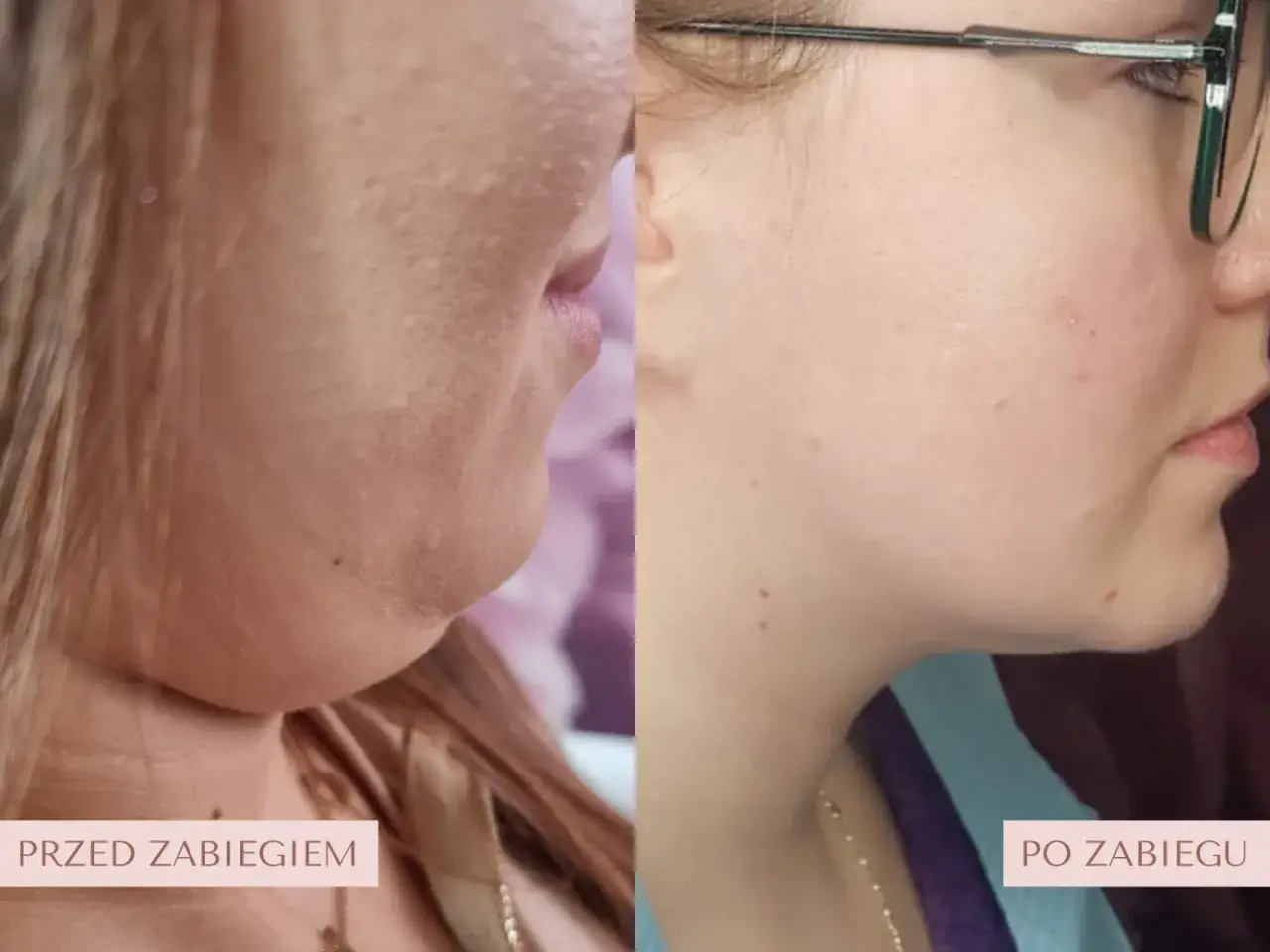 Lipoliza iniekcyjna efekty po 1 zabiegu: wyraźne wyszczuplenie podbródka, zredukowana podwójna broda.