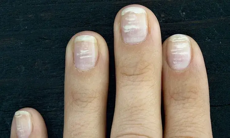 Zielony paznokieć: Infekcja bakteryjna? Leczenie i profilaktyka