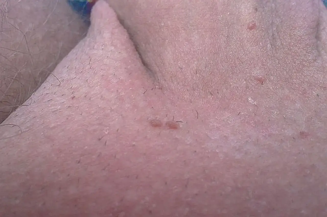 Kłykciny HPV: Do kogo iść? Dermatolog czy Urolog rozstrzygnięte