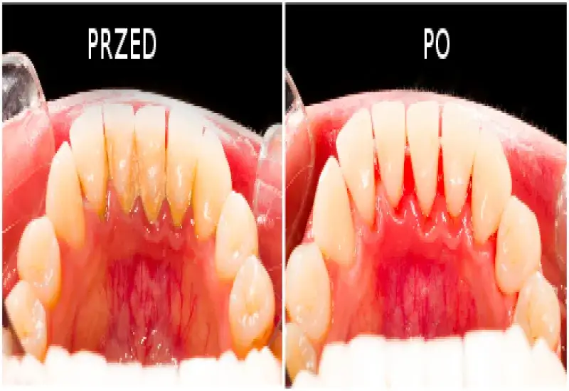 Skaling zębów: Bezbolesna droga do zdrowych dziąseł i bieli?