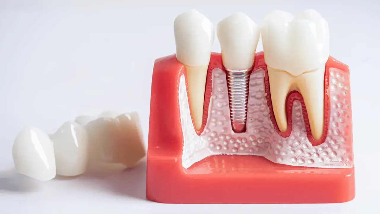 Jak długo wytrzymują implanty zębów? Poznaj fakty i czynniki wpływające na trwałość