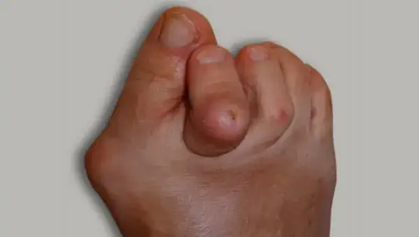 Palec jeździecki: objawy, przyczyny i skuteczne metody leczenia