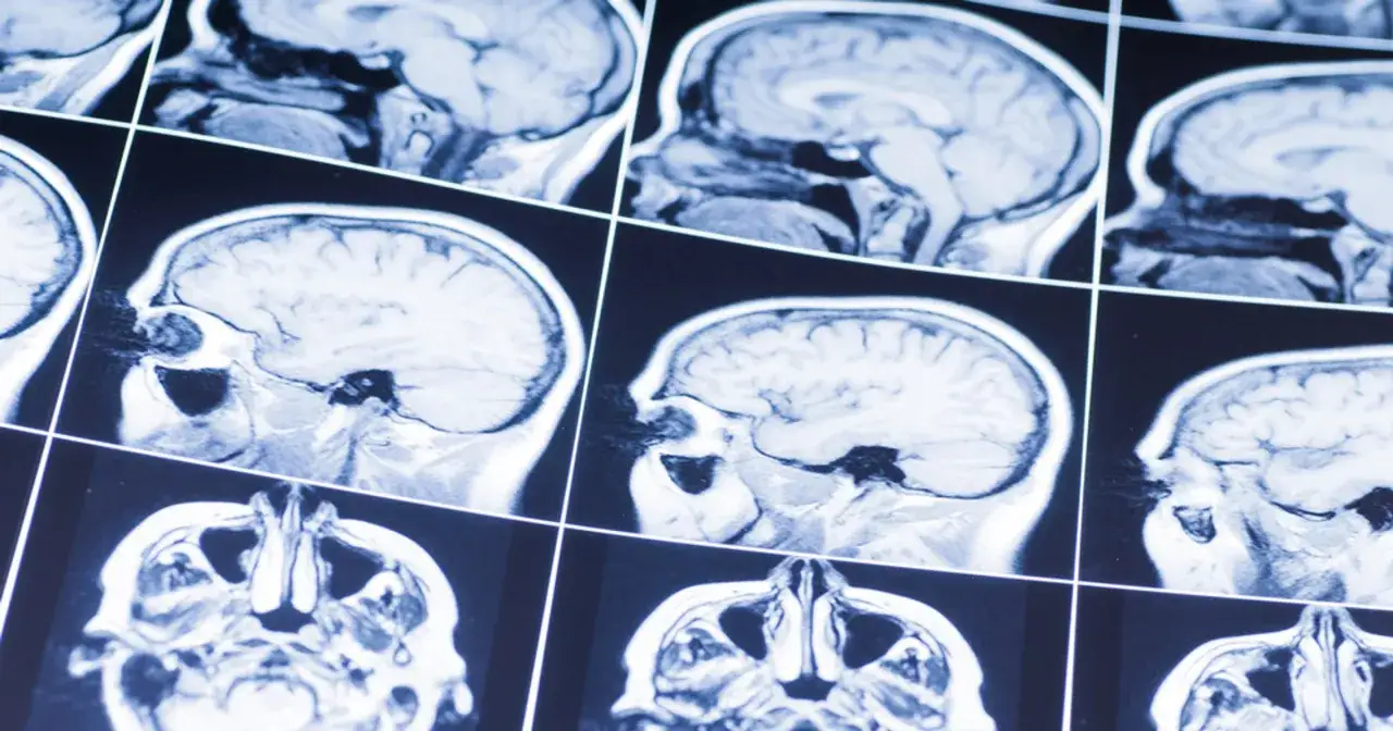 Przyczyny udaru mózgu: Poznaj czynniki ryzyka i jak im zapobiegać