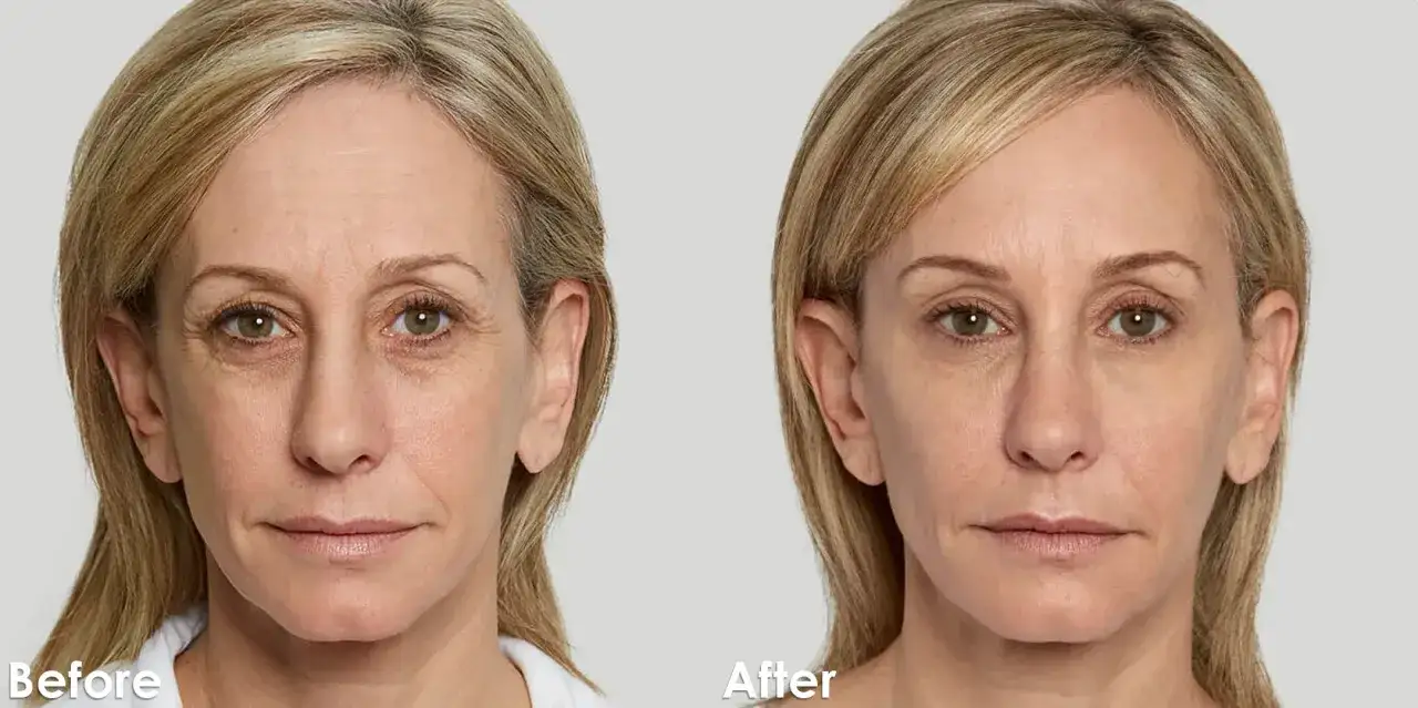 Skuteczne rozwiązania na zmarszczki po 60 – popraw wygląd skóry