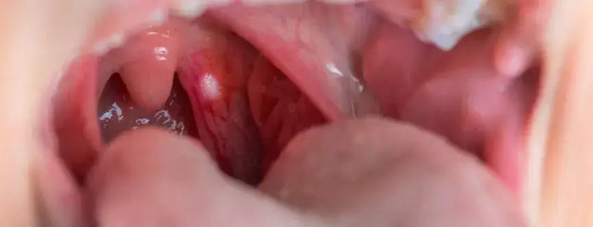 Afty: 10 przyczyn bólu w jamie ustnej. Kiedy iść do lekarza?