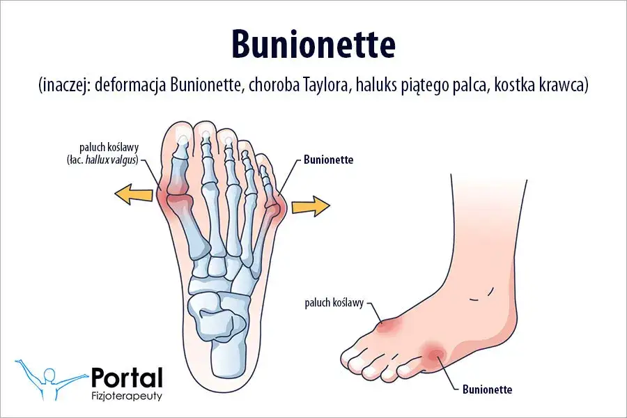 Haluks małego palca: Od domowych metod po operację pełny poradnik