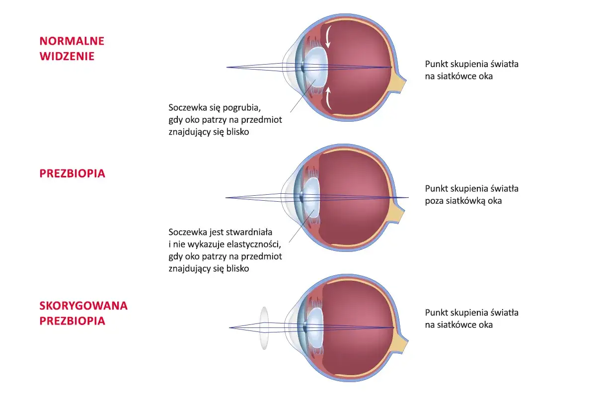 Soczewka wklęsła na krótkowzroczność? Odkryj, jak odzyskać ostry wzrok!