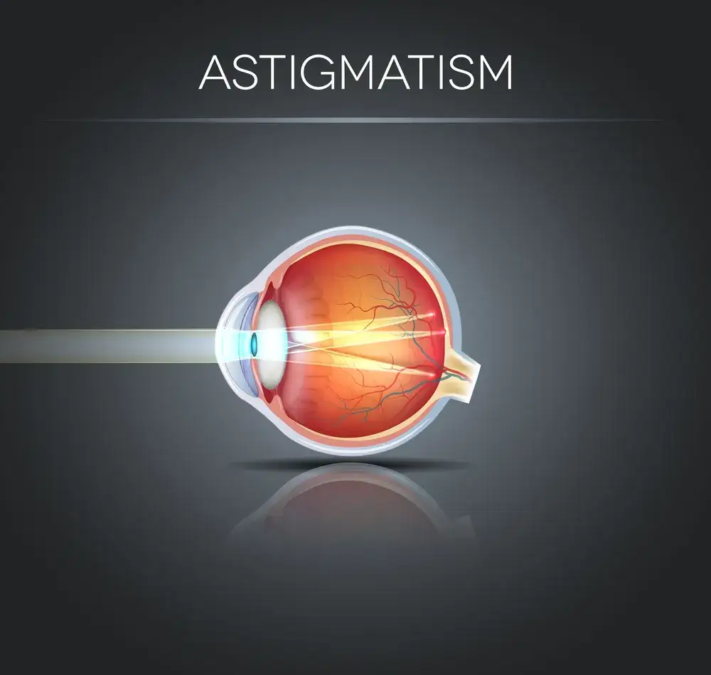 Astygmatyzm: Okulista czy Optometrysta? Sprawdź, kogo wybrać!