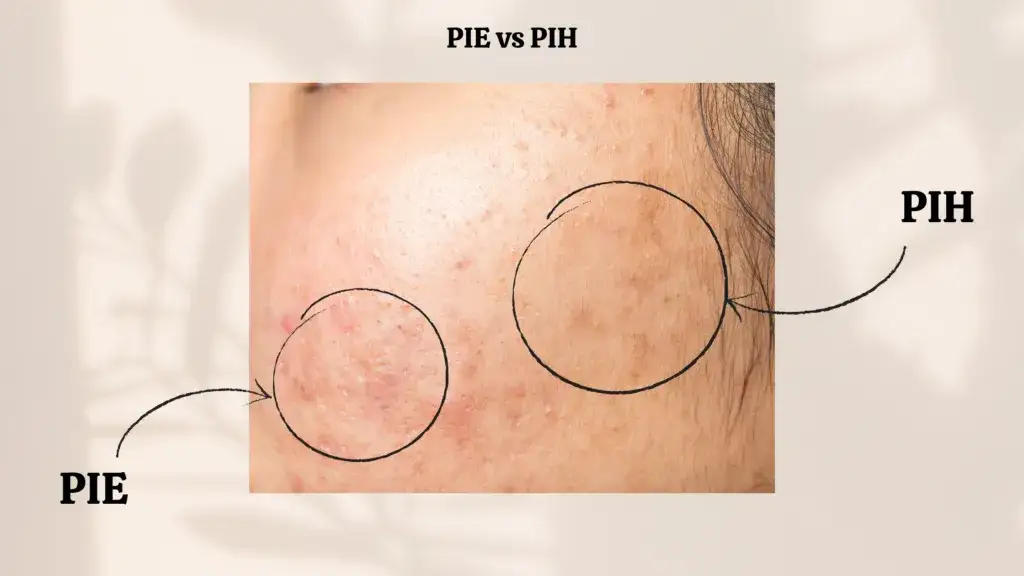 Czerwone plamy po pryszczach: Poznaj skuteczne sposoby na PIE!