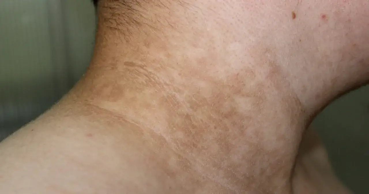 Zmiany skórne na szyi, przebarwienia i drobne krostki. Czy przy cukrzycy się chudnie? To pytanie nurtuje wiele osób.