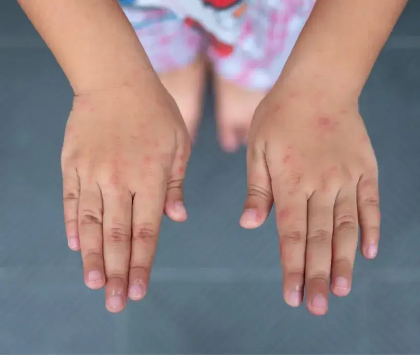 Czy cynamon uczula dzieci? Objawy alergii, które musisz znać