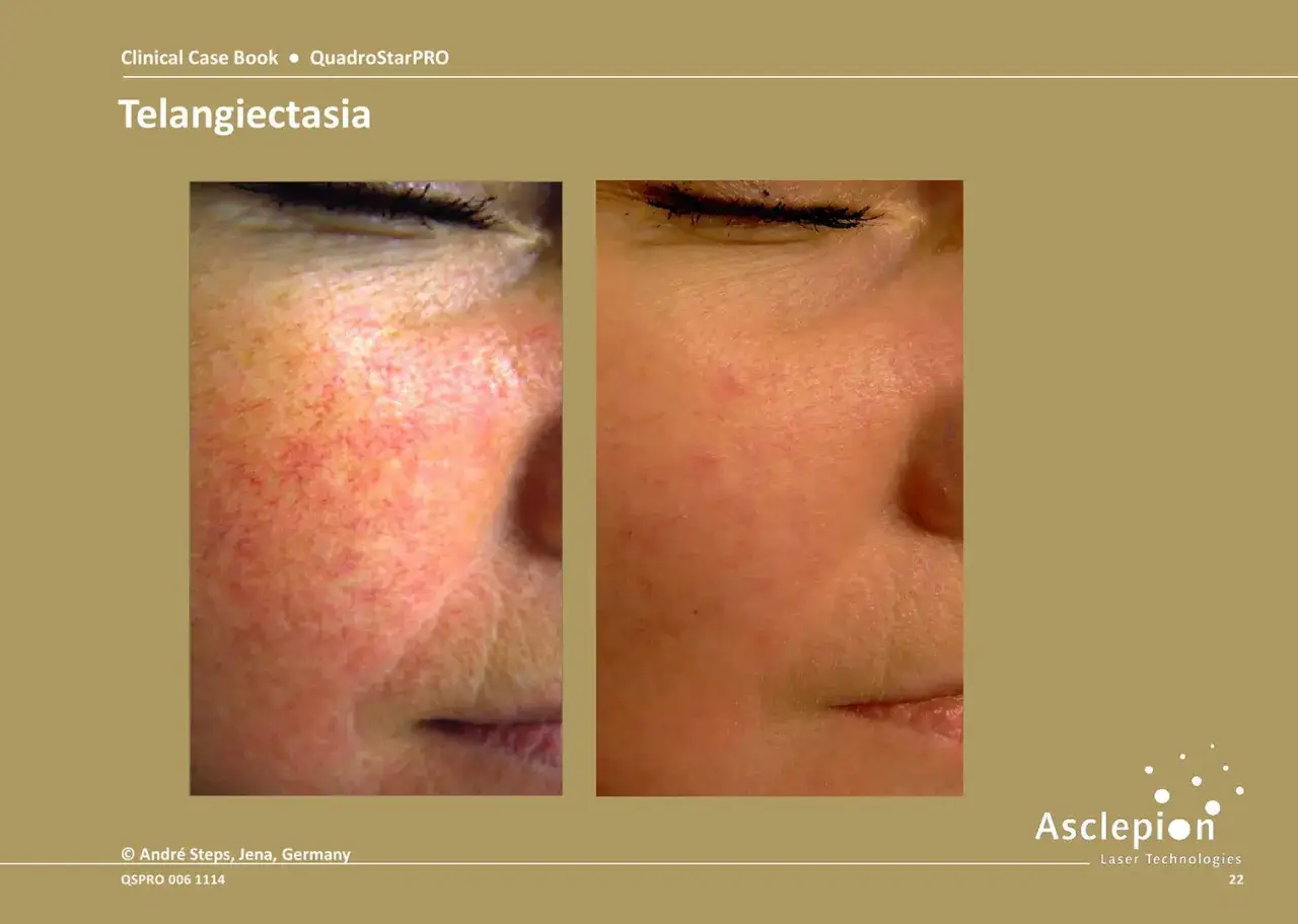 Przed i po laserowym usuwaniu rumienia. Skóra z widocznymi naczynkami przed zabiegiem i gładka po.