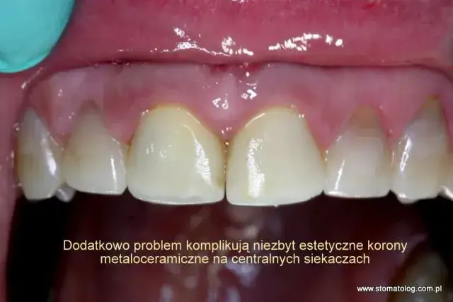 Przebarwienia zębów po antybiotyku u dziecka: jak usunąć?