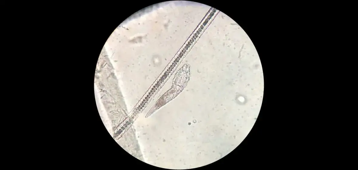 Jak stosować olejek herbaciany na nużeńca, aby skutecznie leczyć skórę
