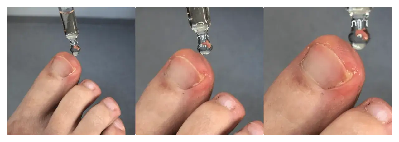 Jak usunąć dzikie mięso przy paznokciu? Skuteczne metody i profilaktyka