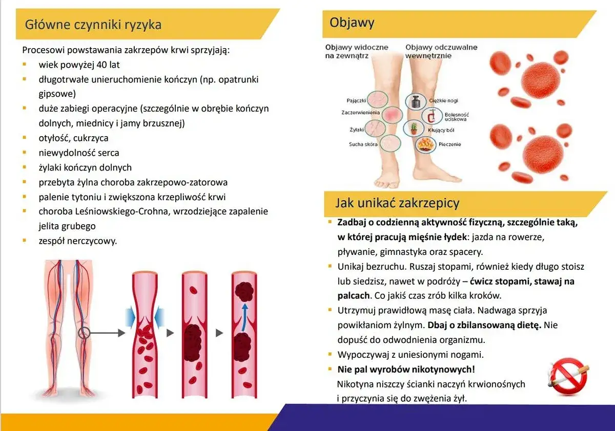Jak zapobiec zakrzepicy? 4 filary dla zdrowych żył. Sprawdź ryzyko!