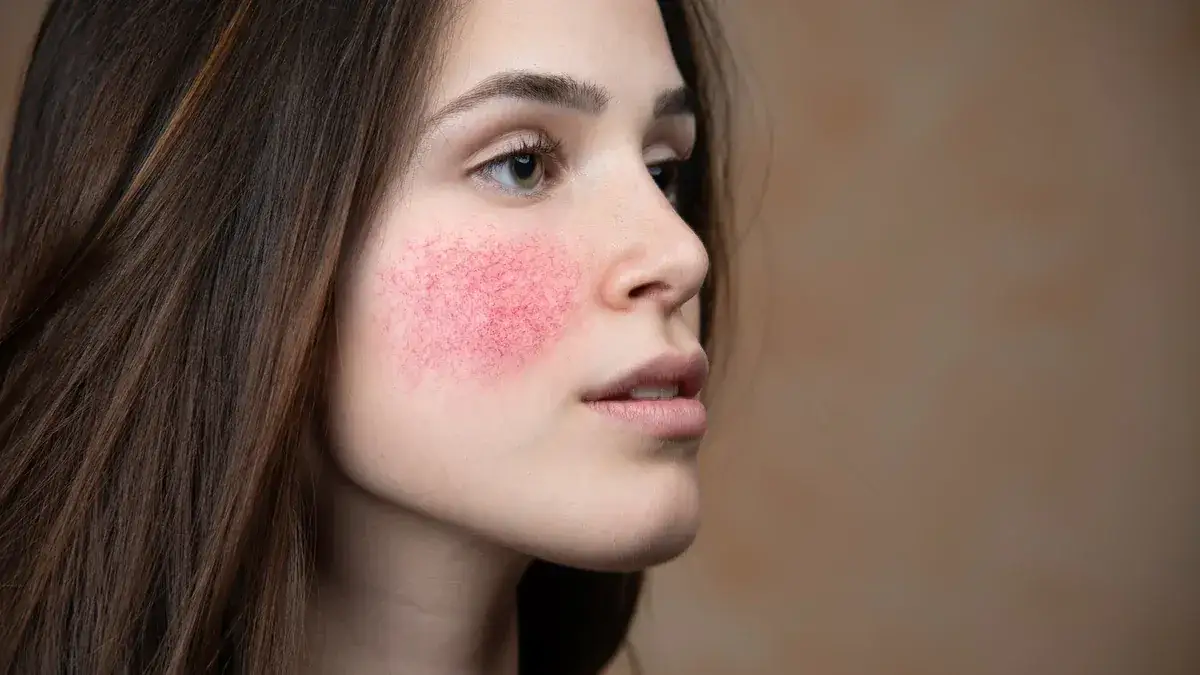 Cera naczynkowa objawy: Rozpoznaj i uniknij trądziku różowatego!