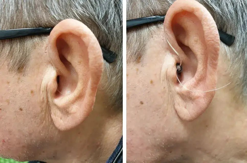 Jak załatwić aparat słuchowy na NFZ i uniknąć zbędnych kosztów