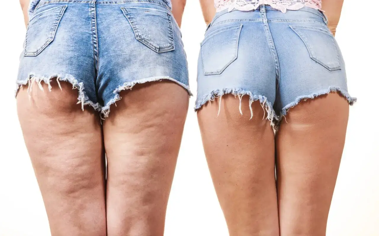 Cellulit na udach: Kompleksowy plan na gładką skórę!