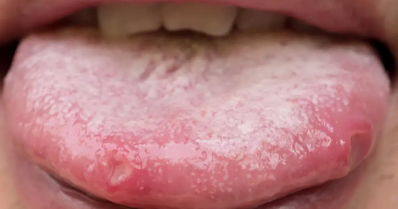 Objawy cukrzycy w jamie ustnej – jak je rozpoznać i co zrobić, by je złagodzić