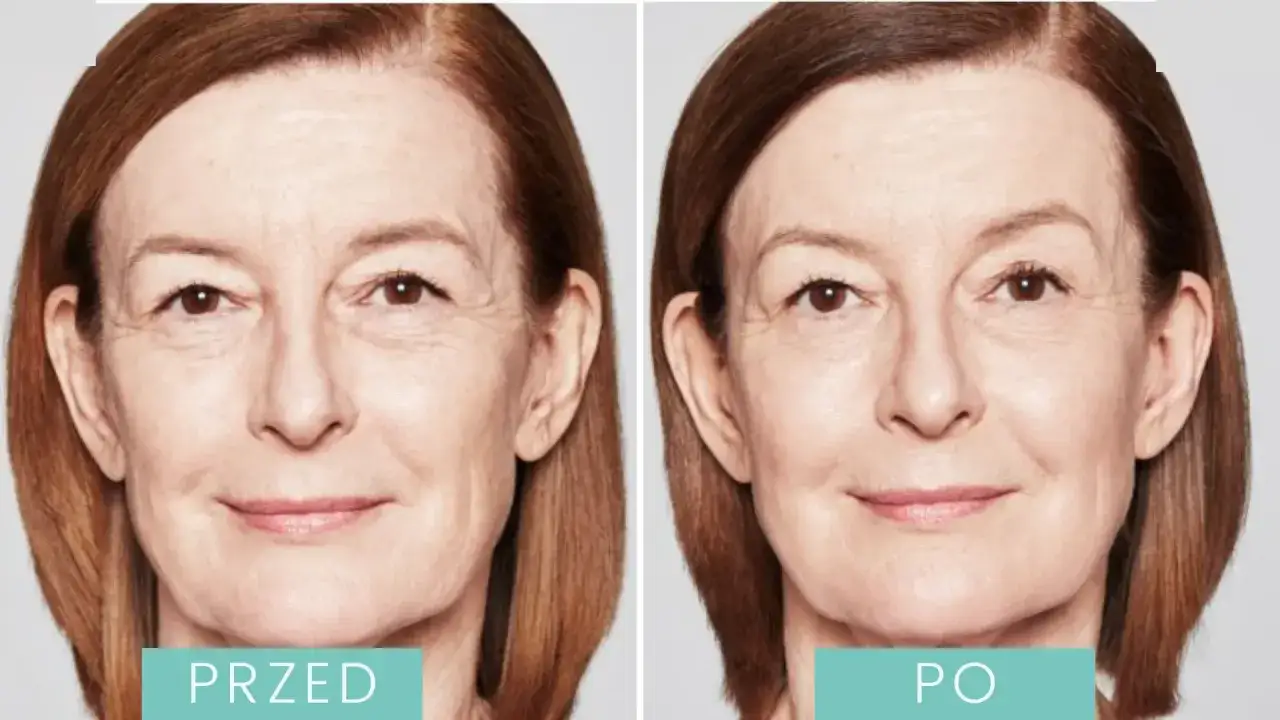 Kwas polimlekowy czy hialuronowy - co wybrać dla piękniejszej skóry?