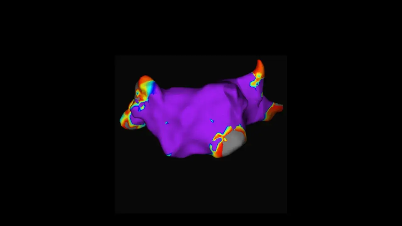 Skuteczne leki na migotanie przedsionków: Wybierz bezpieczną terapię