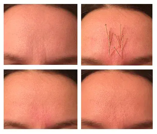 Akupunktura Twarzy: Naturalny Lifting i Efekty Przed i Po