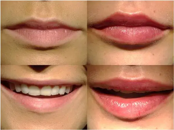Kwas hialuronowy w ustach – jak długo utrzymuje się efekt?
